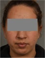 22 year old female with left promient ear