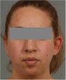 22 year old female with left promient ear