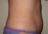 truSculpt