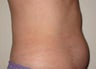 truSculpt