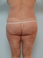 Body Lift