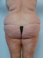 Body Lift