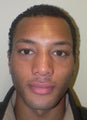 34 year old man has Rhinoplasty