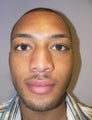 34 year old man has Rhinoplasty