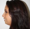 Nose Surgery