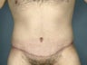 Male Abdominoplasty