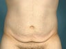 Male Abdominoplasty