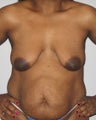 Mommy Makeover on 42 Year Old Woman