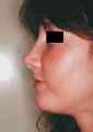 Chin Implant
