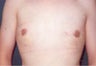 Male Breast Reduction Surgery