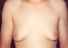 Male Breast Reduction Surgery