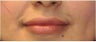 Permanent lip augmentation with Permalip implant in a young women