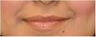 Permanent lip augmentation with Permalip implant in a young women