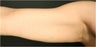 SmartLipo MPX
