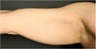 SmartLipo MPX