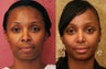 African American Rhinoplasty
