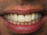 Crown Replacement & Implant Crown Before & After Photo