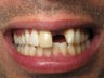Crown Replacement & Implant Crown Before & After Photo