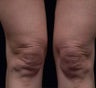 Thermage body