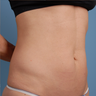 truSculpt
