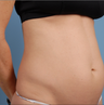 truSculpt