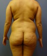 Brazilian Butt Lift