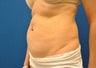 CoolSculpting