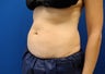 CoolSculpting