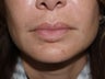 Extensive repair of scarring and deformity as a result of silicone and BioPolymer lip injections