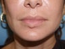 Extensive repair of scarring and deformity as a result of silicone and BioPolymer lip injections
