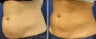 CoolSculpting Treatment