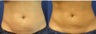 CoolSculpting Treatment