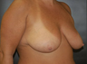Breast Lift
