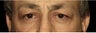 Male Patient who underwent a Lower Lid Blepharoplasty