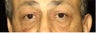 Male Patient who underwent a Lower Lid Blepharoplasty