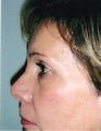 Revision rhinoplasty in 61 year old woman