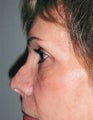 Revision rhinoplasty in 61 year old woman