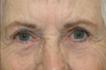 Right lower eyelid full thickness defect