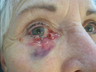 Right lower eyelid full thickness defect