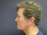 Neck Lift