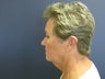 Neck Lift