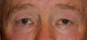 Eyelid Surgey and Brow Lift