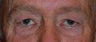 Eyelid Surgey and Brow Lift