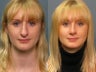 Nose Surgery