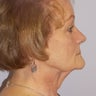 Facelift