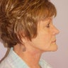 Facelift