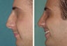 Primary Male Rhinoplasty Patient