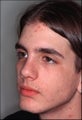Rhinoplasty after an injury