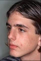 Rhinoplasty after an injury