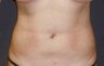 Liposuction